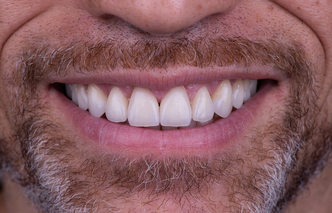 Όψεις ρητίνης ή πορσελάνης για αισθητική αποκατάσταση χαμόγελου
